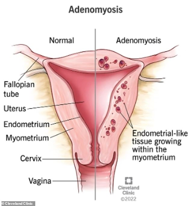 It is not known exactly why adenomyosis occurs.  But the NHS notes that it is 'likely' that women with adenomyosis 'have a predisposition due to their genes, immune system and hormones'