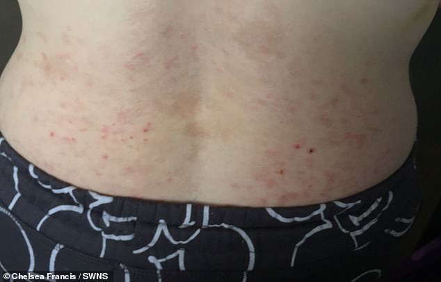 Bedbug bites covered mum-of-two Chelsea Francis' back, the family have now moved into a hotel and new accommodation will be found for them soon