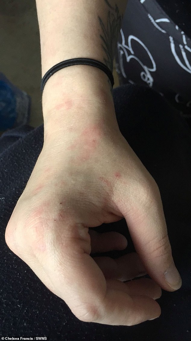 Bedbug bites on Mrs. Francis' hand and wrist.  She said: 'It was awful and so gross knowing you were being spied on all the time.  It was like a nightmare