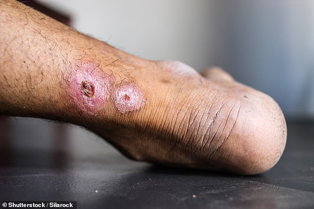 Leishmaniasis results in skin ulcers or even organ damage