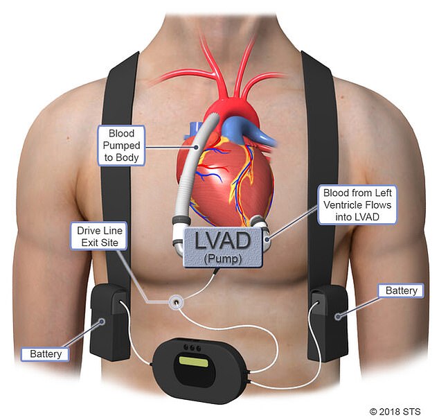 An LVAD keeps blood flowing through the body by mechanically pumping the left side of the heart