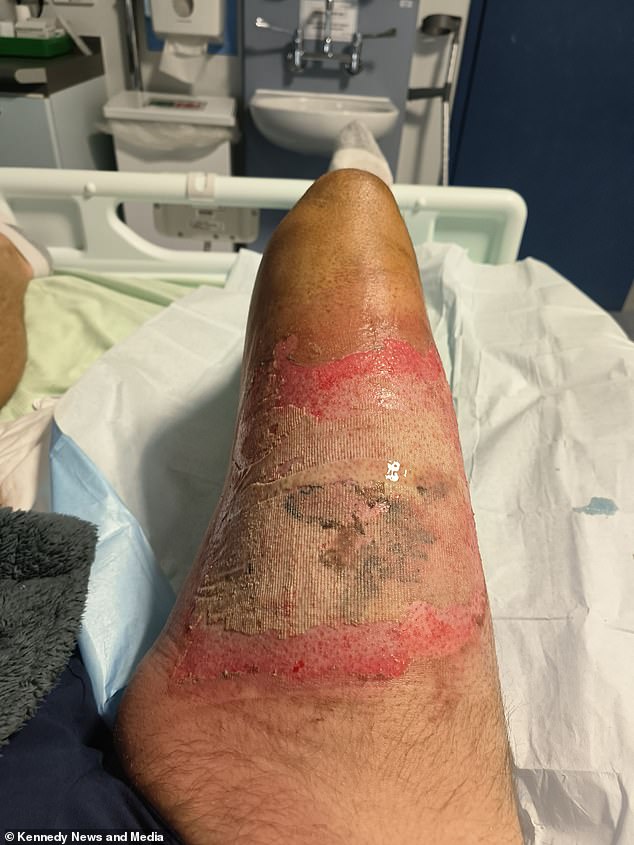 Doctors provided pain relief and managed to scrape off the scorched flesh and bandage his leg at Airedale Hospital in Steeton