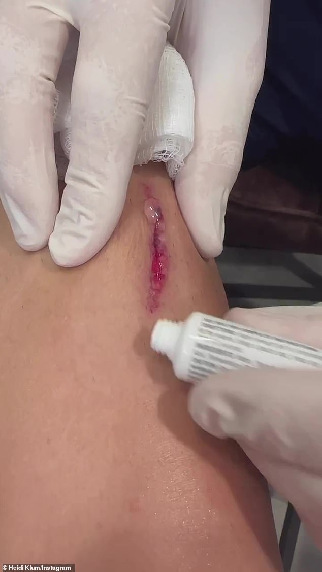 Ouch!  Doctors applied glue to Klum's wound to soften the scars