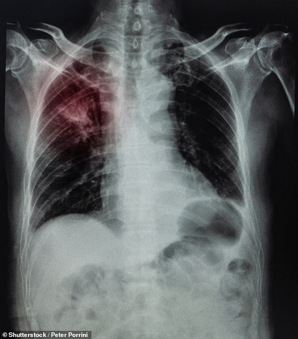 Silicosis is caused when materials such as artificial stone countertops are cut dry and workers inhale small particles of silica dust.  Pictured: A chest x-ray showing in red the impact of silicosis on the lungs)