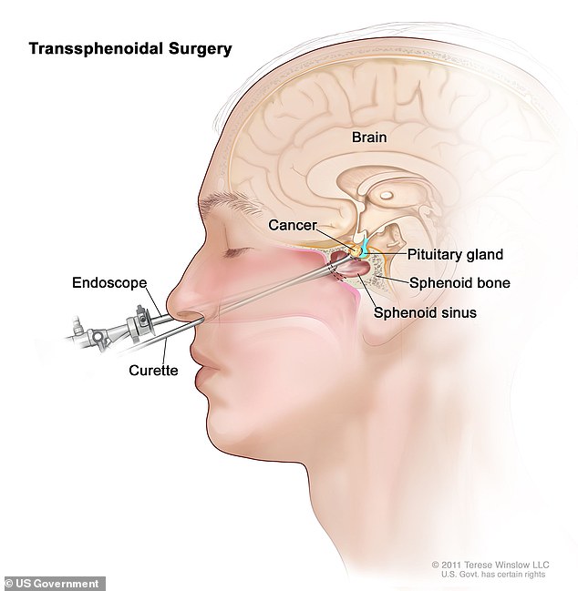 The above shows how Ms Courtier had surgery on the brain tumor, which is normally removed via devices inserted through the nose to access the tumor