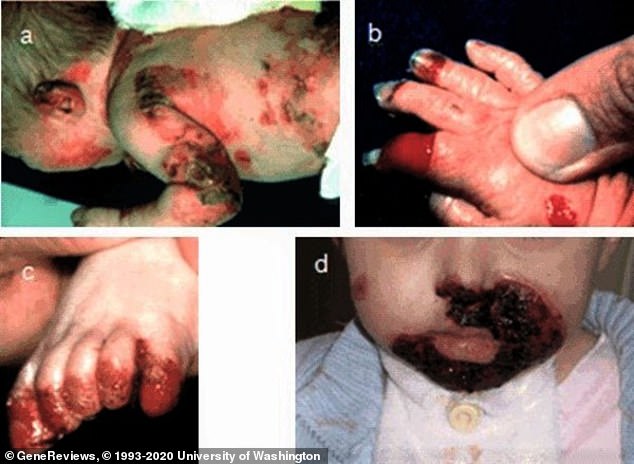 Any trauma or friction to the skin can cause painful blisters in patients with Junctional epidermolysis bullosa