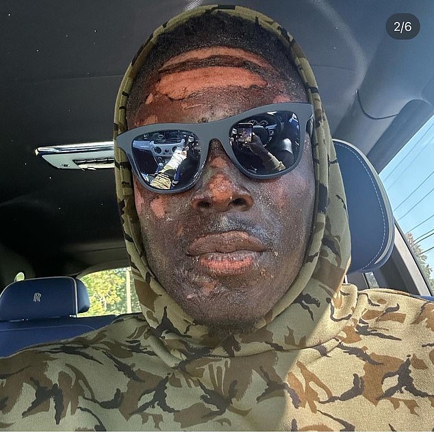 David Njoku revealed the facial burns he suffered in a domestic accident last month