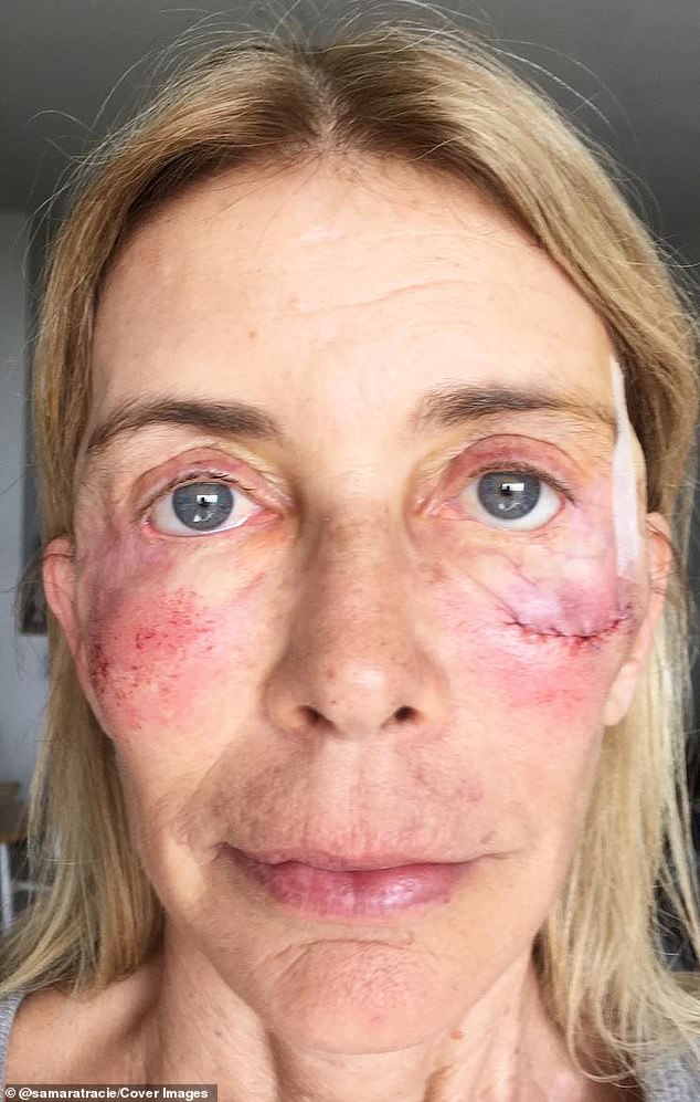 Tracie Samara, 61, (pictured after procedure) narrowly escaped permanent blindness after winning a competition that promised her a free cosmetic procedure