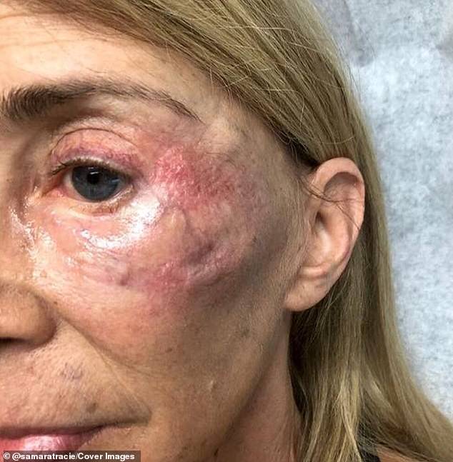 She has revealed the horrific results of her botched 'facial rejuvenation' that left her scarred for life (shown after the procedure)