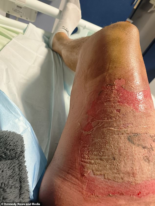 Dave Johnson, 41, from Colne, suffered second-degree burns after his vape battery 'exploded'