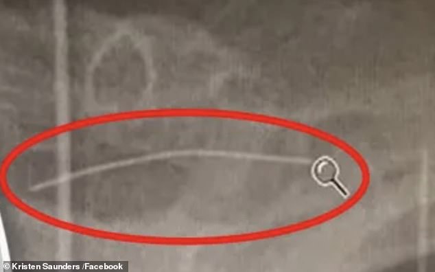 Kristen Saunders wrote on Facebook that her daughter swallowed a piece of wire (shown in an x-ray) from a brush used to clean barbecues, which was in the roll purchased at a local restaurant