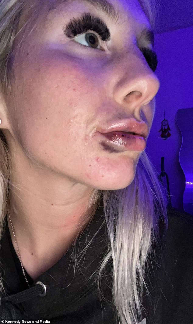 Natalie Overton (pictured), 24, from Denbighshire has warned others about the dangers of 'cheap' lip fillers after the procedure left her with 'sausage lips' (Here Natalie is pictured undergoing the procedure)