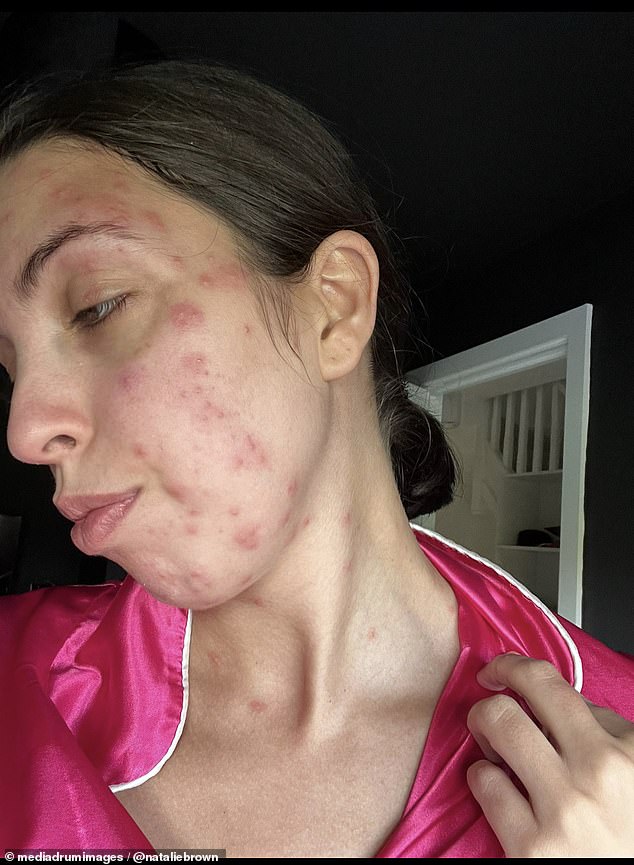 Natalie Brown (pictured), 28, was covered in bedbug bites after spending three days on holiday in Benidorm, Spain