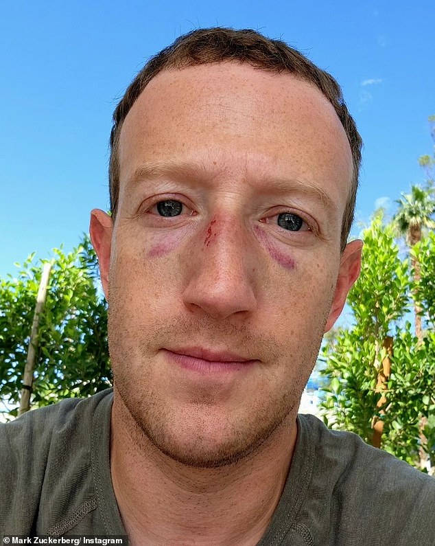 META CEO Mark Zuckerberg posted a photo on Instagram showing two black eyes