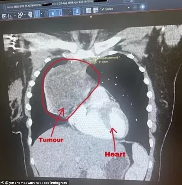 On September 10, a scan (pictured) revealed the huge mass growing next to her heart