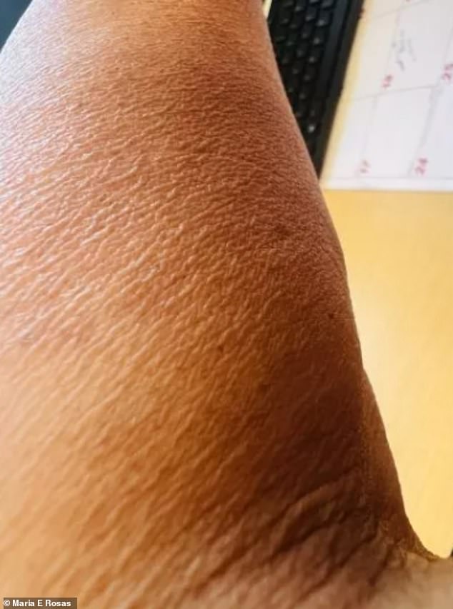 Dr.  Maria Rosas, who lives in Texas, said her skin broke out in a rash a week after starting Ozempic (pictured).  She also had a burning sensation in her back and genitals