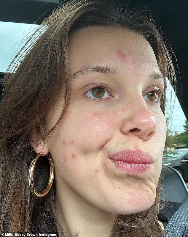 Zits!: Millie Bobby Brown literally bared herself, spots and all, when she shared a photo showing several pimples on her face and forehead.  'Thank you for normalizing pimples.  ¿¿' wrote one grateful fan