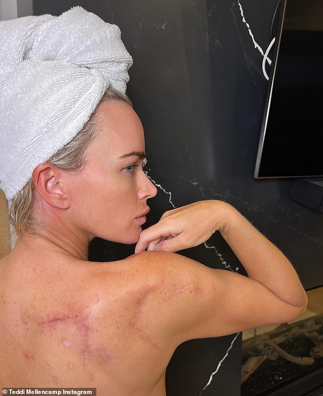 Holding pattern: Teddi Mellencamp, 42, revealed that her current immunotherapy cream regiment had not been effective in treating her skin cancer after she started it earlier in October