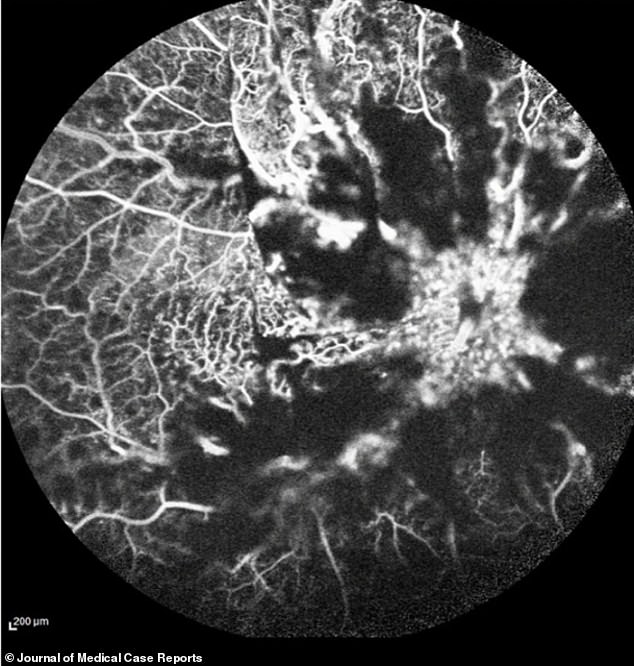 This scan shows the damage caused by blockage of blood vessels in the 32-year-old man's right eye