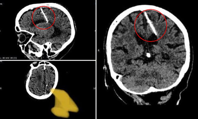 The three-centimeter-long needle was inserted through the woman's soft spot at the top of her head as a newborn.  She was the victim of a botched infanticide allegedly committed by her parents during the World War II-induced famine in the Soviet Union