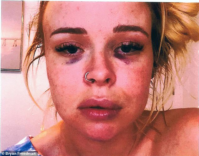 Bauer's accuser, Lindsey Hill, is pictured with bruises around her eyes