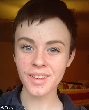 After Sydney developed severe cystic acne at age 15, her doctor discovered she had elevated androgen levels.  She was given hormone treatment to make her 'normal'