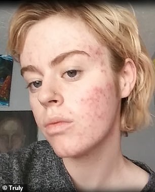 After Sydney developed severe cystic acne at age 15, her doctor discovered she had elevated androgen levels.  She was given hormone treatment to make her 'normal'