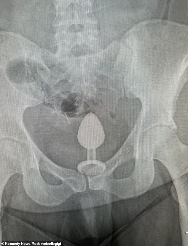 An X-ray showed the sex toy was 'so far up' even doctors admitted they 'didn't know how to get it out'