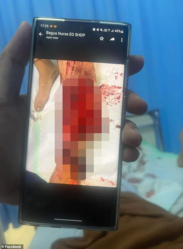 Mr Villablanca's sister shared a graphic photo of his shin, showing the skin and muscle torn away, leaving part of the bone exposed