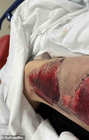 The daring motorcyclist developed a rash from sliding on the rough surface