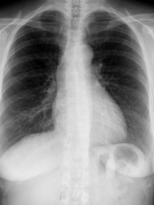 An x-ray of healthy lungs for comparison with the x-ray below