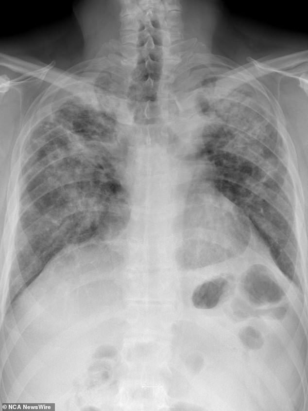 An x-ray of lungs affected by silicosis with progressive massive fibrosis.  Photo: courtesy of Bruno Di Muzio, Radiopaedia.org