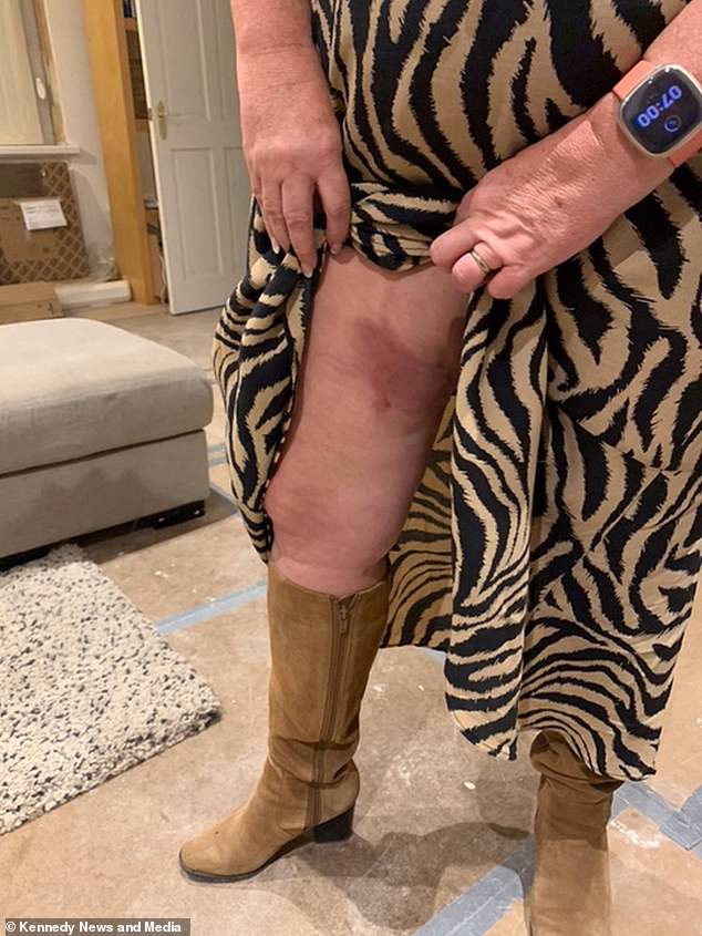 Tracy, from Water Orton, Warwickshire, says a flight attendant 'wobbled' and accidentally poured the boiling liquid onto her lap, burning her thighs through a thin dress