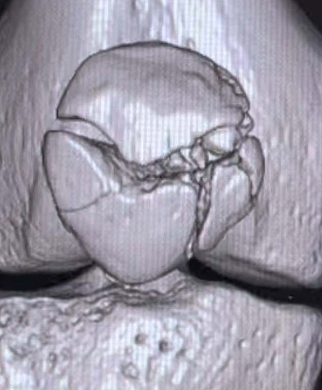 The X-ray of the serious knee injury that Papenhuyzen suffered in 2022, showing his shattered kneecap