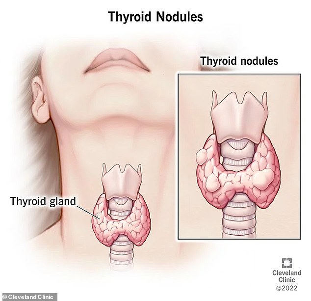 The thyroid is a gland in the front of the neck that is responsible for making hormones that control how the body uses energy