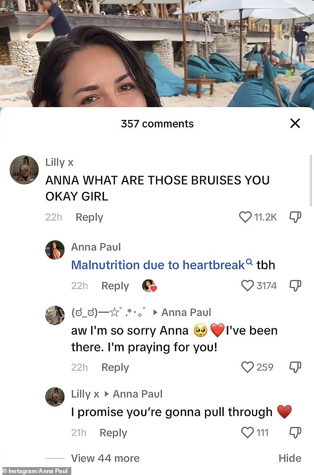 After a follower raised concerns about the X-rated star's health, Anna revealed in the comments that her bruising and weight loss happened after her split from her long-time boyfriend Glen Thomson.