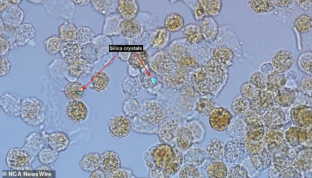 Cells from the lungs of a patient with silicosis.  Notice that the speck of silica dust shines brightly