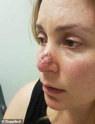 The mother had to wait five weeks before doctors cut into her nose and removed the squamous cell carcinoma