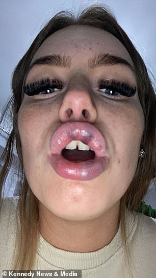 Ms Keeler was left with swollen lips and purple spots after getting lip filler for the second time