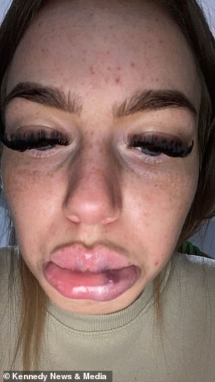 The swelling lasted for two weeks and prevented her from closing her mouth properly