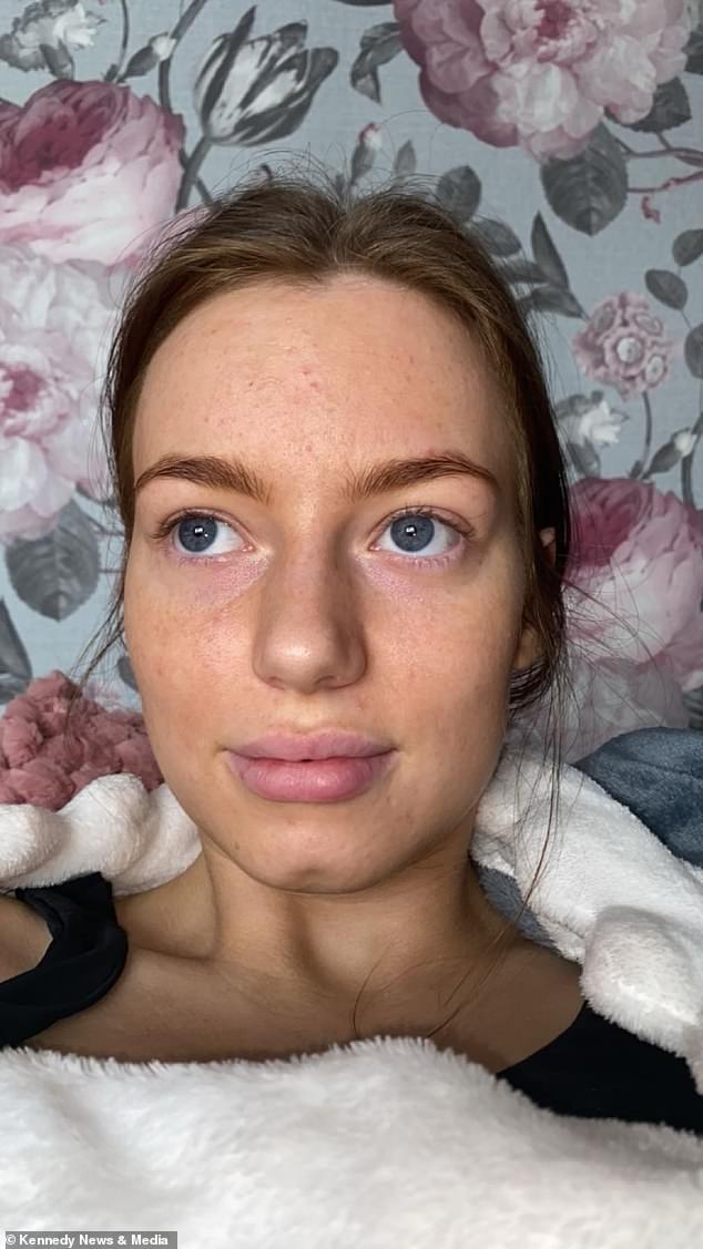 Ms Keeler said it took a fortnight for the bruising to go away and said her lips are still uneven six months later and she had to use lipstick to cover up the botched job.