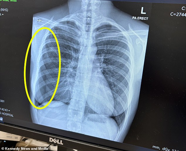 Mrs Smith, who looked at her first X-ray after being sent home, said she could not understand how the doctor could not have discovered something was wrong with her lung.  The image shows her collapsed right lung, circled in yellow compared to the functioning left lung (on the right side of the image)