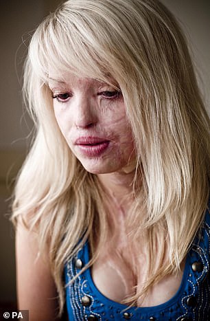 Katie (pictured in 2009) suffered horrific injuries after Stefan Sylvestre, then 19, threw acid at her in 2008