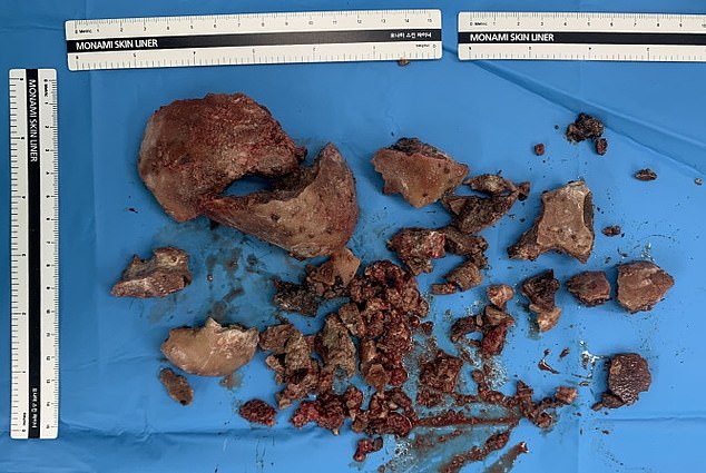 Another vaginal stone from another case in a patient from South Korea