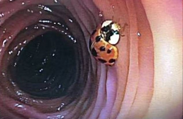 Doctors found a fully intact ladybug in the colon of a Missouri man during a regular colonoscopy