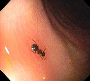 An ant was found in the colon of a 66-year-old man