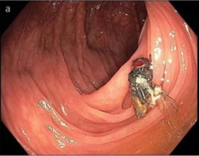 The above image, which the patient gave permission to share, shows the fly as it was found in his intestines.  It didn't move when poked