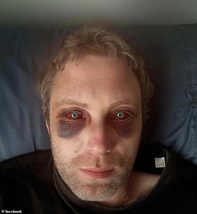 With two black eyes, Jeremy explained that his injuries were self-inflicted after spending the night in a police cell several days earlier