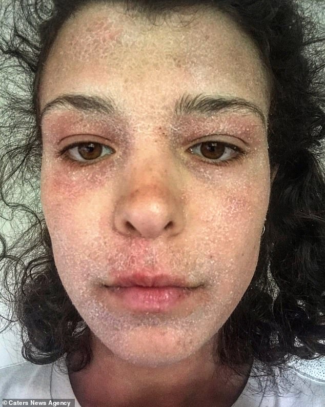 Alice, 23, relied on steroids to get rid of her eczema for eight years.  But she noticed that her skin only got worse.  She is depicted in her retreat