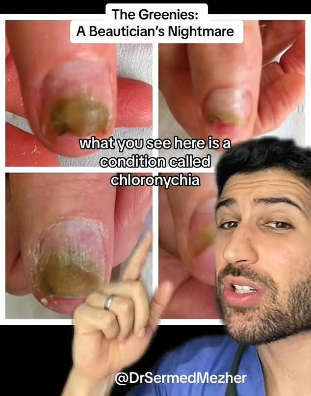 According to Dr Sermed Mezher, a GP working in Britain, all too often the false claws are not applied correctly, leaving a gap between the actual nail and the acrylic nail.